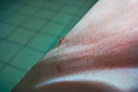 Chen Zhe , The Bearable: Body/Wound #010, 2008 , WHITE SPACE