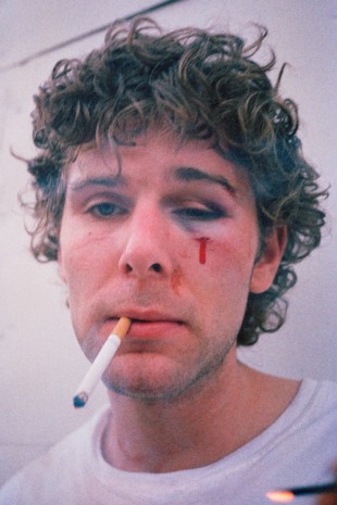Ryan McGinley, Dan (Bloody Eye), 2002 , team (gallery, inc.)